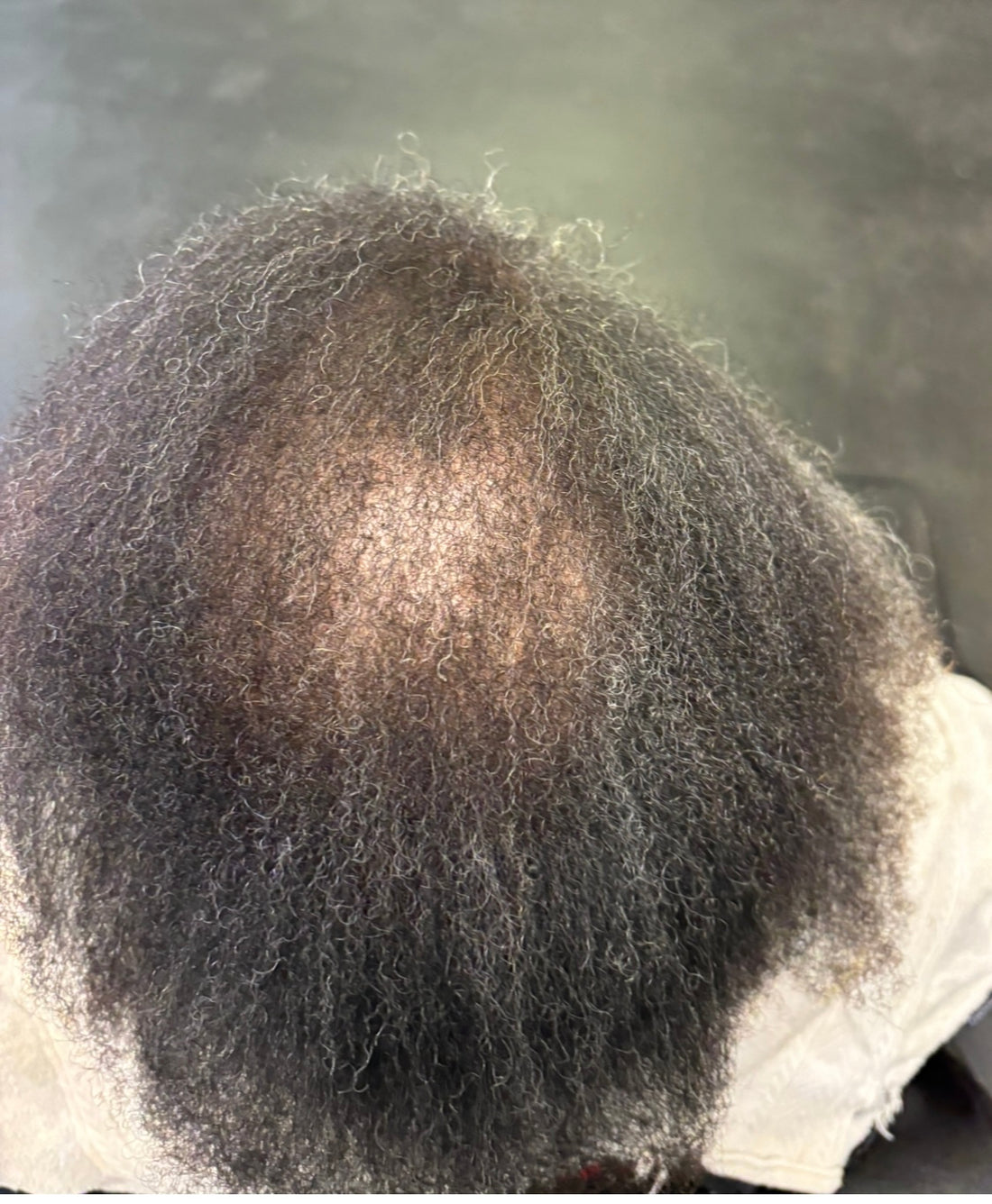 Top view of a person's scalp showing significant hair thinning at the crown